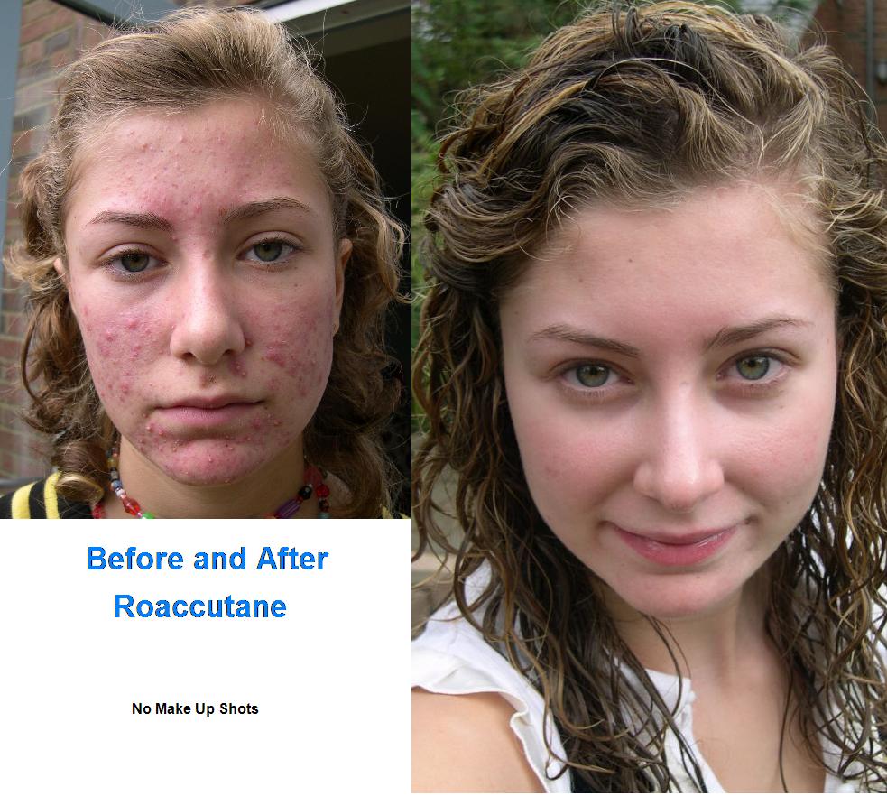 OMFG] Roaccutane avant/après sur le forum Blabla 18-25 ans - 11-07 ...