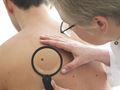   Early detection method to save the life of a new skin cancer 