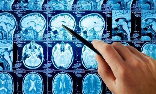   Computerized tomography can increase the risk of brain cancer 